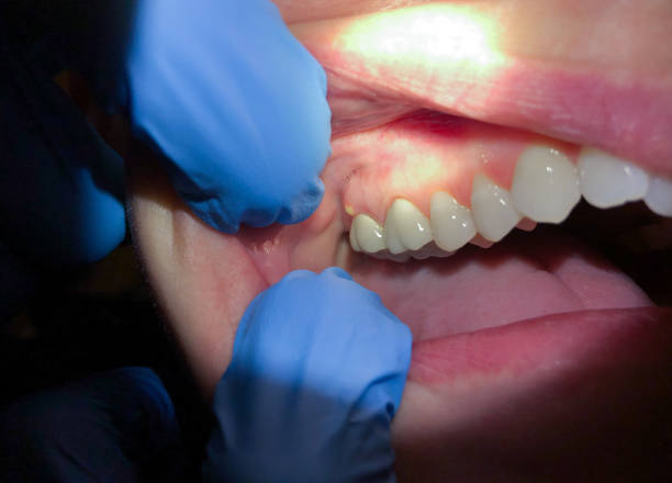 Best Emergency Dental Extractions in Calvert, TX